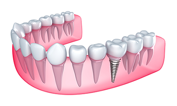 Dental Implants
 - Buford, GA